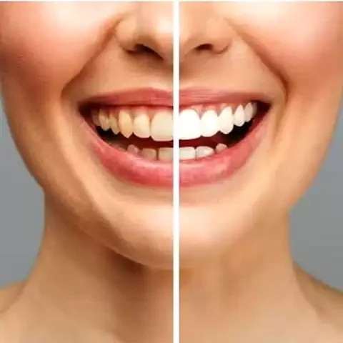 Clareamento Dental