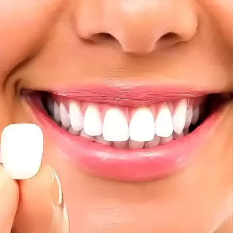 Lentes de Contato Dental